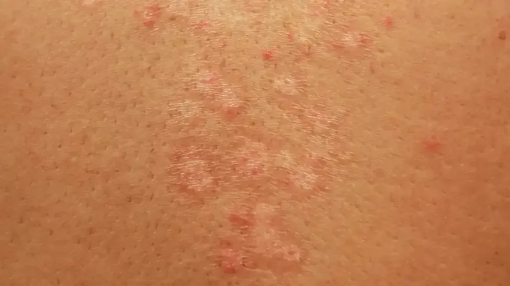 چگونه می‌ توان عفونت قارچی را درمان کرد؟